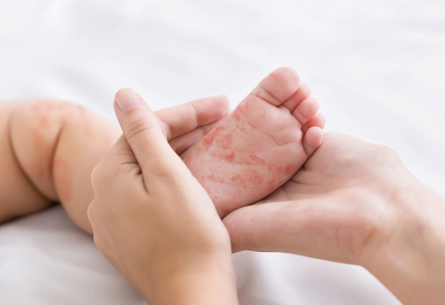 baby foot infected with measles