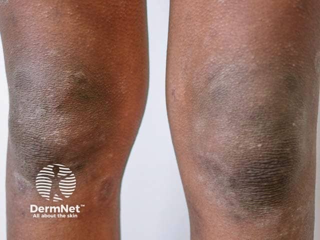Lichenification and hyperpigmentation on the knees in skin of color due to atopic eczema