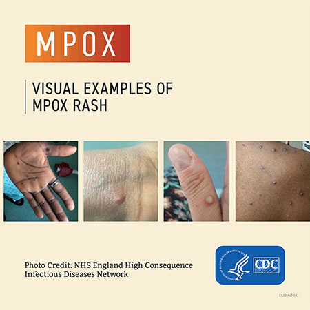 mpox raised bumps on hands, wrist, thumb, and back; source CDC