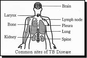 showing common sites of TB: brain, larynx, lymph, bone, pleura, lung, kidney, spine